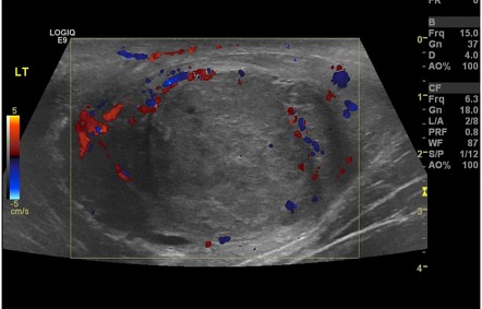 orchitis radiopaedia seminoma testicular radiology