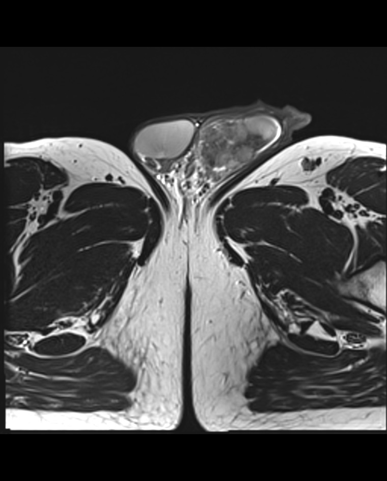 Testicular Seminoma Image