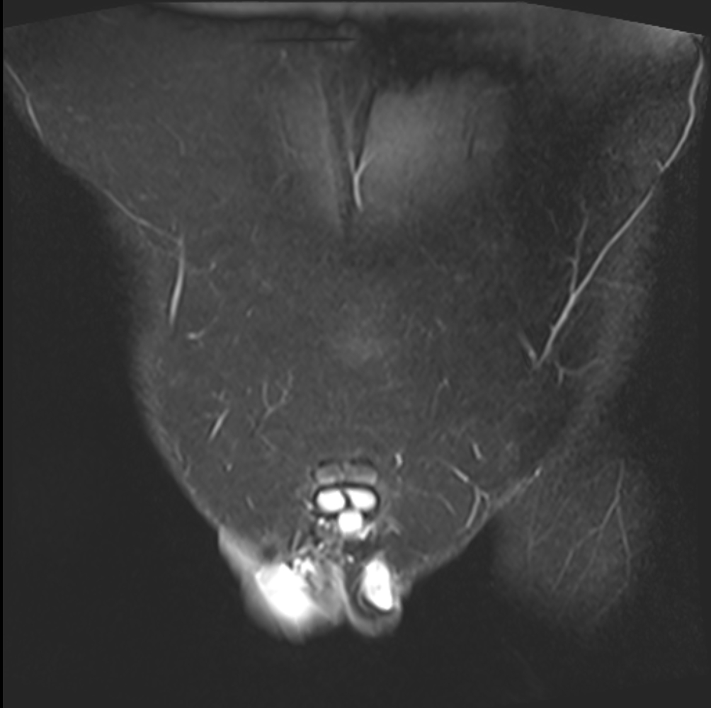 Atrophic testis | Image | Radiopaedia.org