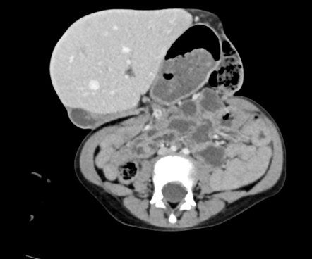 Omphalocele | Radiology Case | Radiopaedia.org