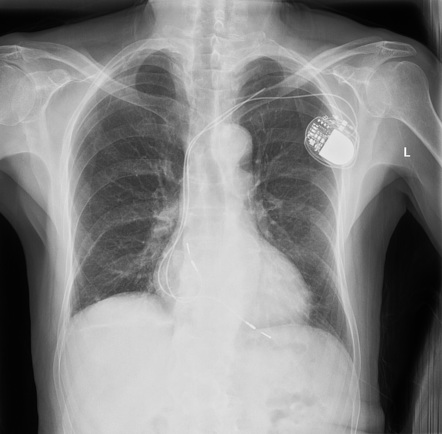 Cardiac conduction devices | Radiology Reference Article | Radiopaedia.org