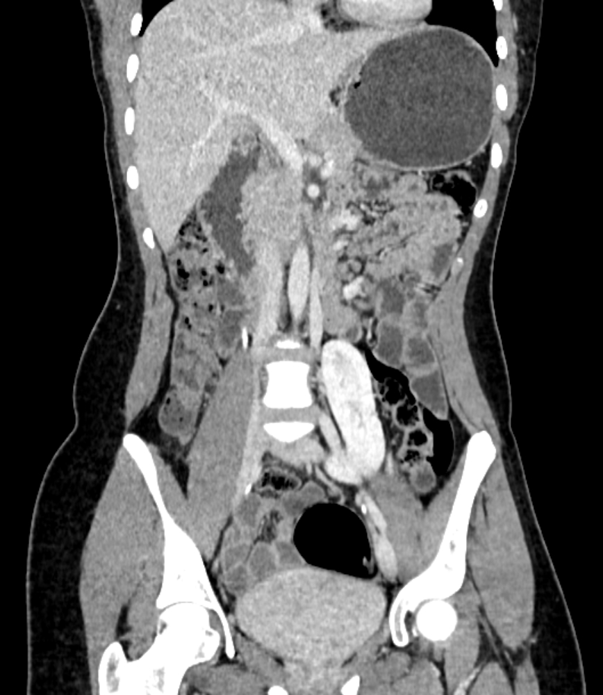 Ectopic kidney | Image | Radiopaedia.org