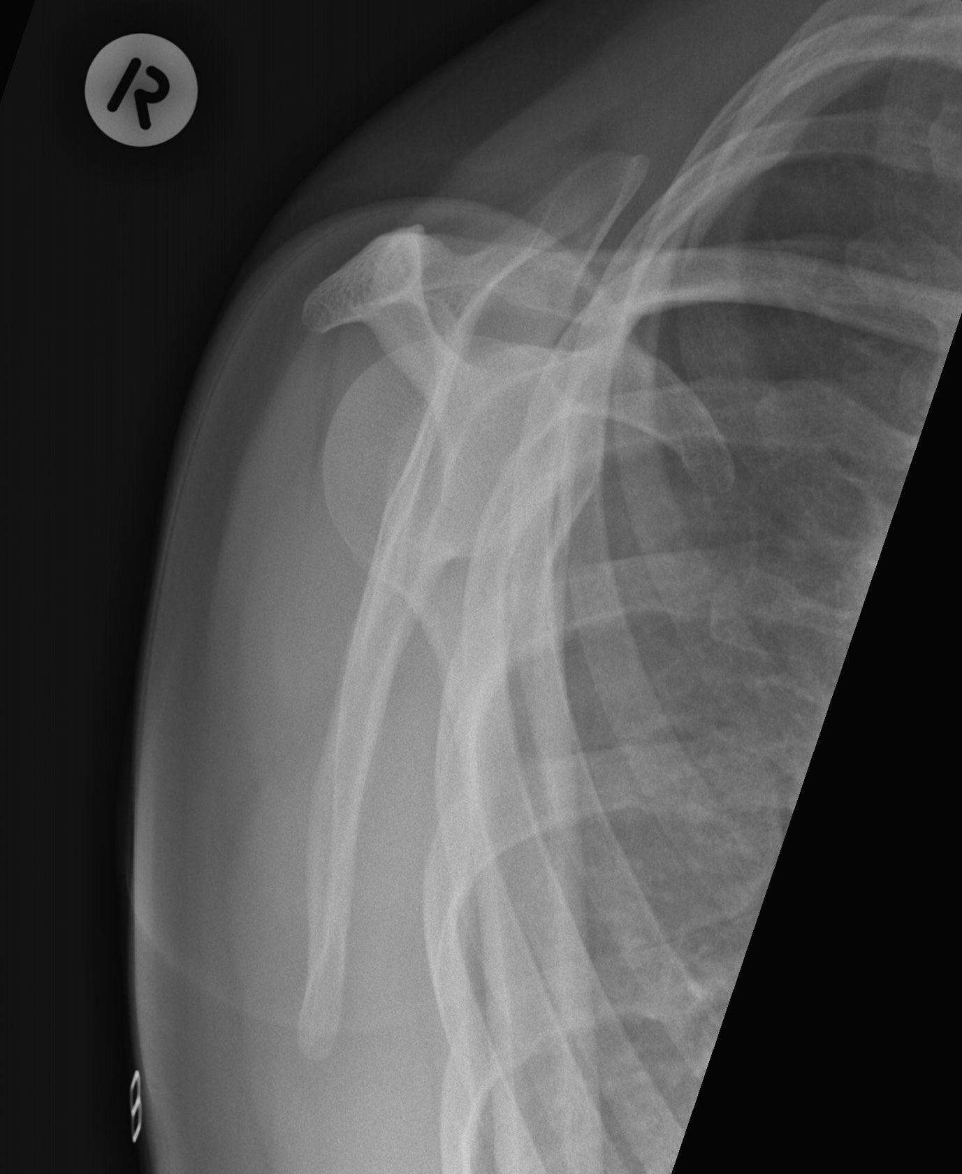 Sternoclavicular Joint Ultrasound