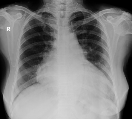 Cardiomegaly Mitral Regurgitation Radiology Case Radiopaedia Org