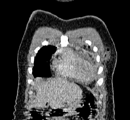 Empyema necessitans | Image | Radiopaedia.org