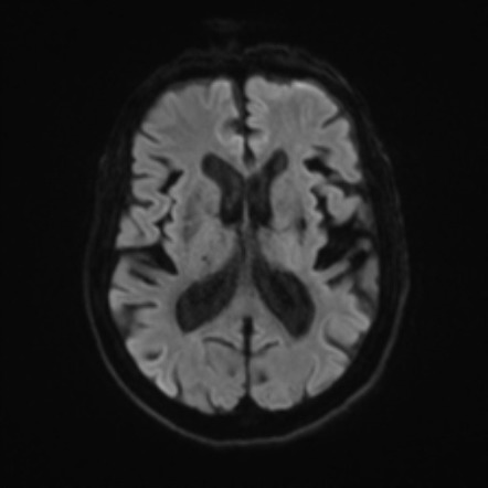 Chronic hypertensive encephalopathy | Image | Radiopaedia.org