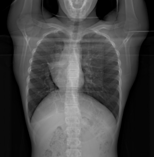 Scimitar syndrome | Image | Radiopaedia.org