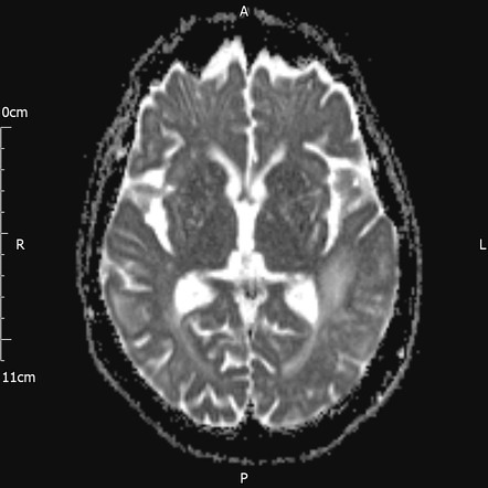 Cerebral Amyloid Angiopathy Related Inflammation | Image | Radiopaedia.org