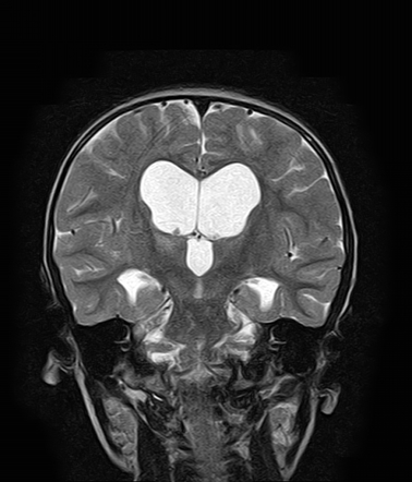 Cerebral Aqueduct Coronal