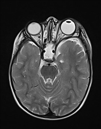 Sphenoid wing dysplasia | Radiology Case | Radiopaedia.org