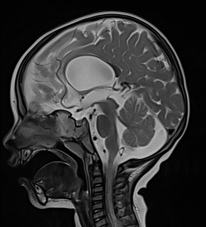 Open Lip Schizencephaly Image Radiopaediaorg