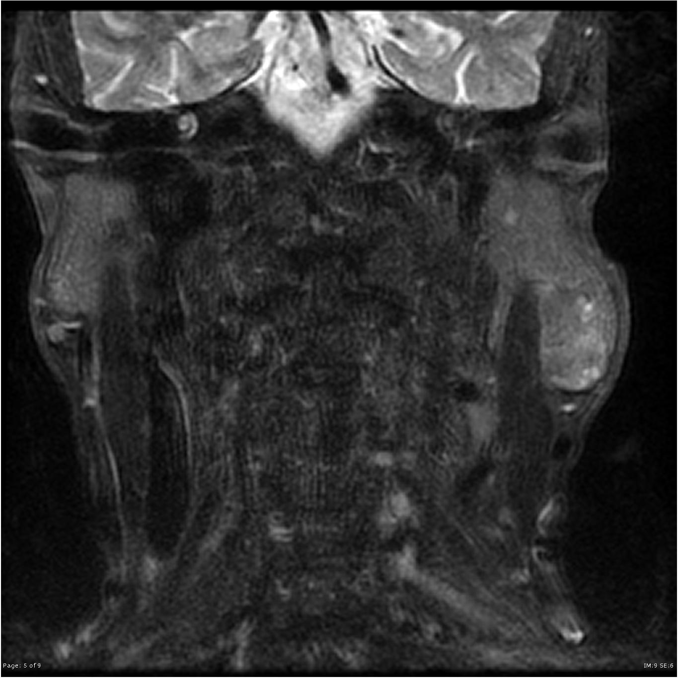 Warthin tumor of the parotid | Image | Radiopaedia.org