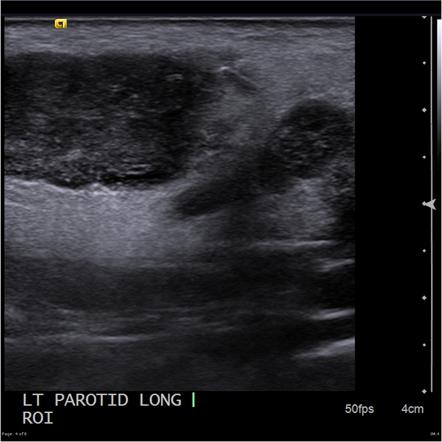 Warthin tumour of the parotid | Radiology Case | Radiopaedia.org