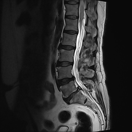 Spinal dural arteriovenous fistula | Image | Radiopaedia.org