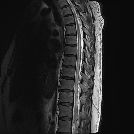 Мрт грудного. Мрт total Spine. Мрт грудного отдела ребра. Изоинтенсивные мрт. Легкие на мрт грудного отдела.