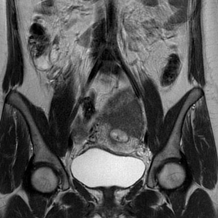 Ovarian serous cystadenocarcinoma | Image | Radiopaedia.org