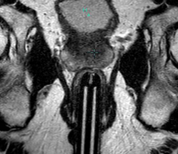 Prostate Cancer Pi Rads 5 Image 9972