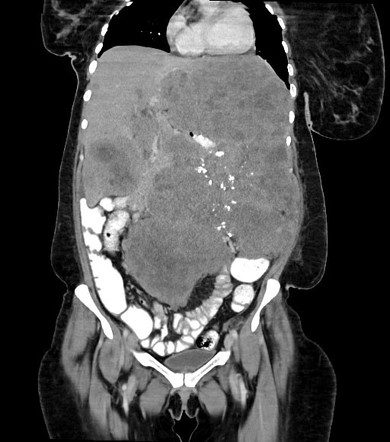 Metastatic gastrointestinal stromal tumor | Radiology Case ...