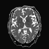 Hypoglycemic encephalopathy | Image | Radiopaedia.org