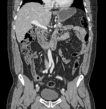 Gastrointestinal stromal tumor (GIST) - stomach | Image | Radiopaedia.org