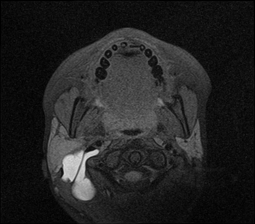 Nuchal Cystic Lymphangioma 