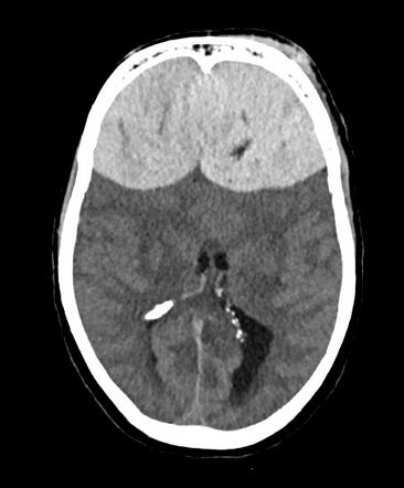 Massive bifrontal extradural hematomas | Radiology Case | Radiopaedia.org