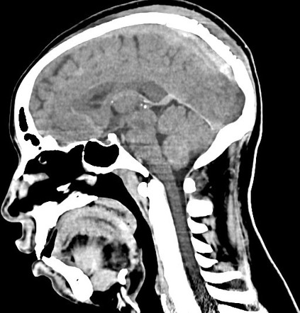 Venous epidural hematoma | Image | Radiopaedia.org