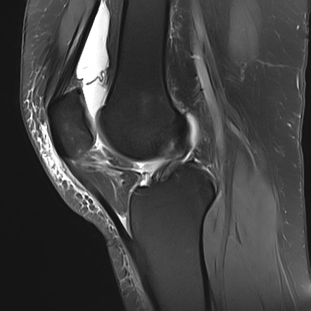 Lateral patellar dislocation | Image | Radiopaedia.org