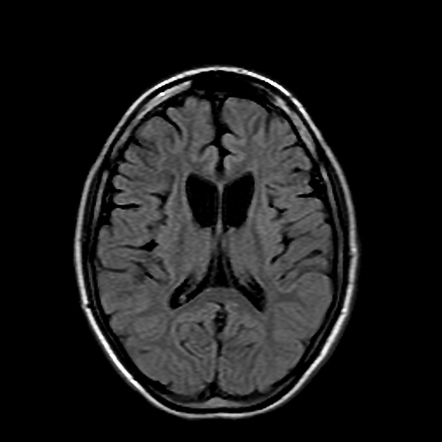 Huntington disease | Image | Radiopaedia.org