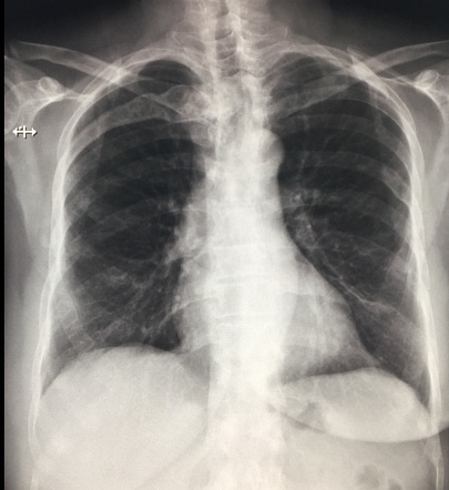 Fibrous dysplasia - rib | Radiology Case | Radiopaedia.org