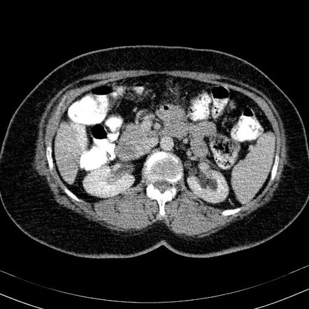 Duplex renal collecting system | Image | Radiopaedia.org