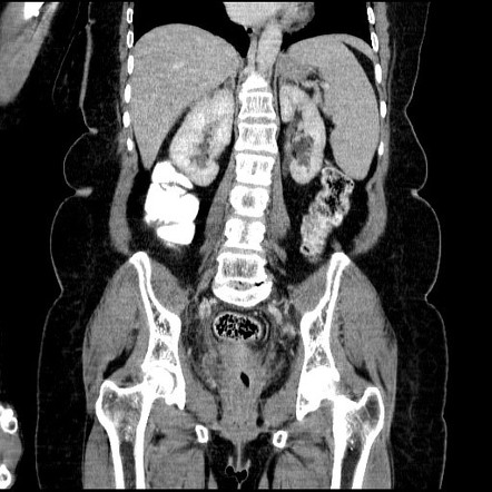 Duplex renal collecting system | Radiology Case | Radiopaedia.org