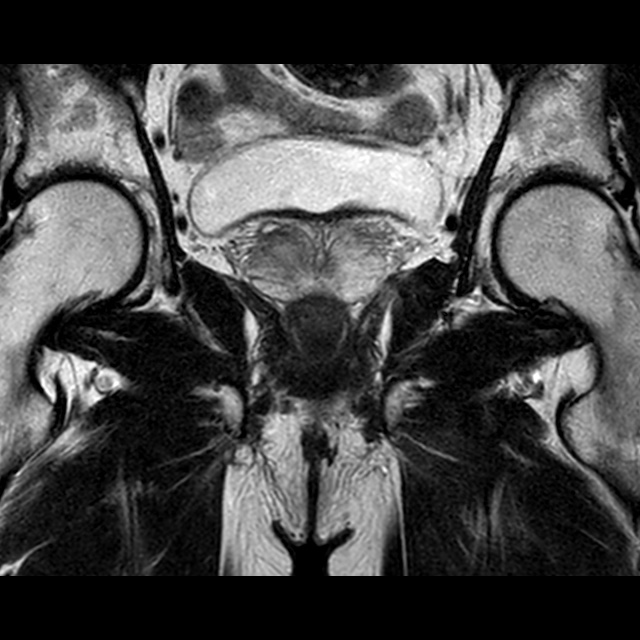 Prostate Cancer - Seminal Vesicle Invasion | Image | Radiopaedia.org