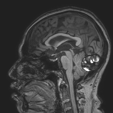 Cavernous hemangioma of the cerebellar falx | Radiology Case ...