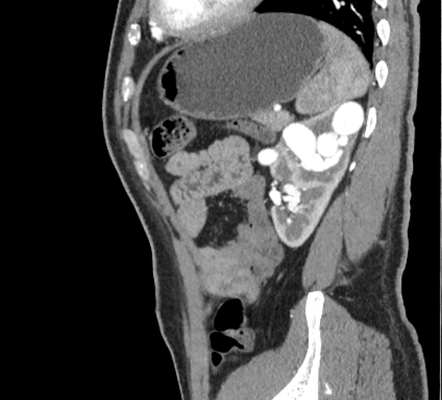 Renal arteriovenous malformation | Image | Radiopaedia.org