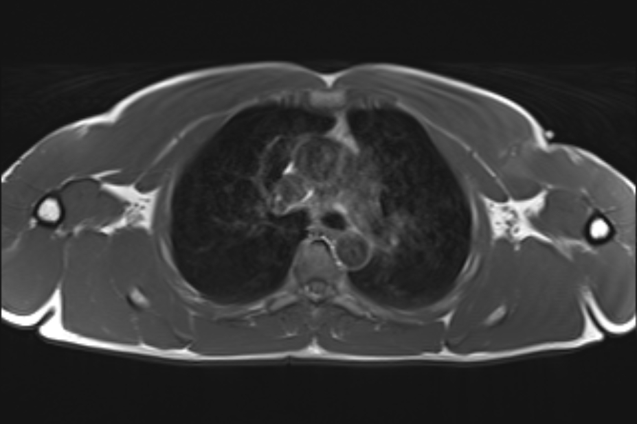 MRI Chest Anatomy