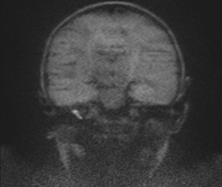 Cholesteatoma | Image | Radiopaedia.org