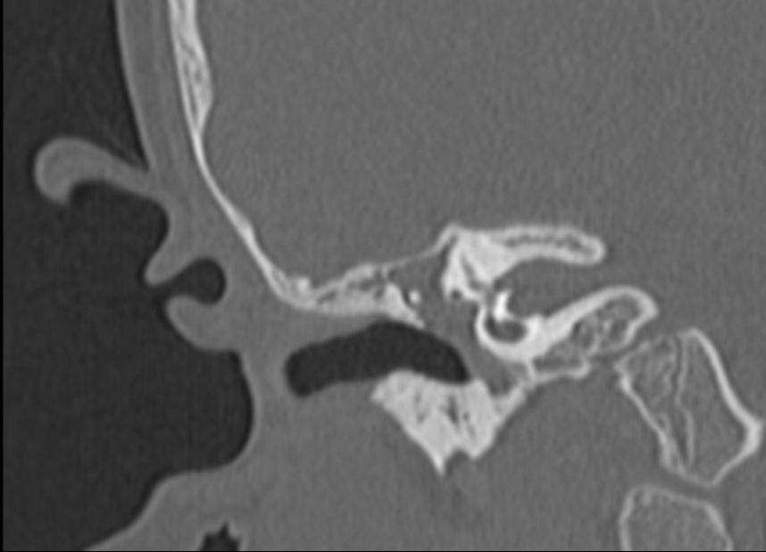 Cholesteatoma | Image | Radiopaedia.org