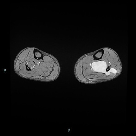 Schwannoma of the tibial nerve | Image | Radiopaedia.org