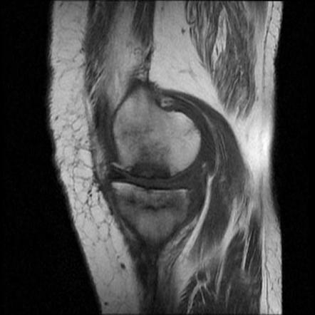 Tibial plateau insufficiency fracture | Image | Radiopaedia.org