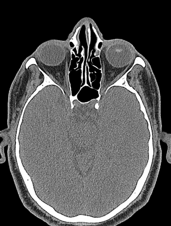 Traumatic lens dislocation | Radiology Case | Radiopaedia.org