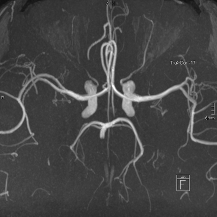 Divry van Bogaert syndrome | Image | Radiopaedia.org