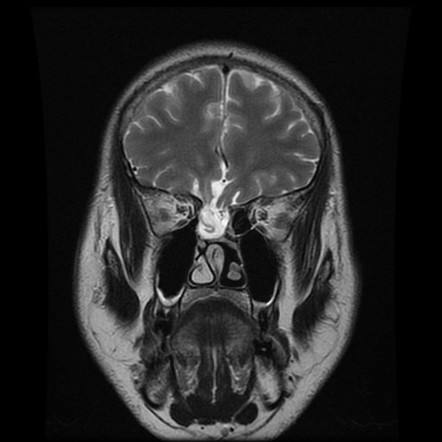 Meningoencephalocele | Radiology Case | Radiopaedia.org