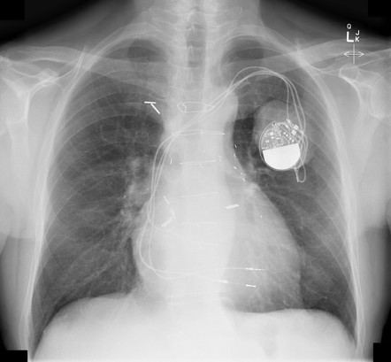 Large pulmonary mass behind pacemaker generator | Radiology Case ...