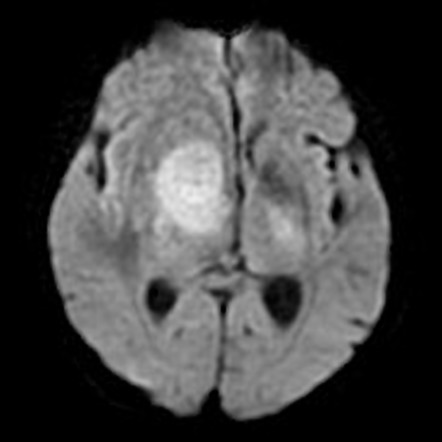 CNS lymphoma | Radiology Reference Article | Radiopaedia.org