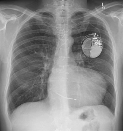 Left ventricular aneurysm | Radiology Reference Article | Radiopaedia.org