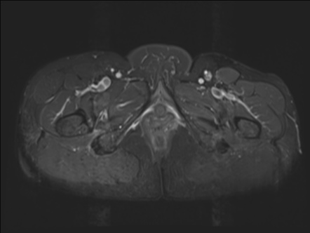 Ischiofemoral impingement syndrome | Radiology Case | Radiopaedia.org