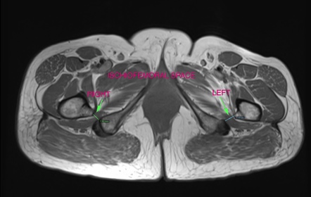 Ischiofemoral impingement | Radiology Reference Article | Radiopaedia.org