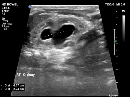 Imperforate hymen in newborn | Image | Radiopaedia.org