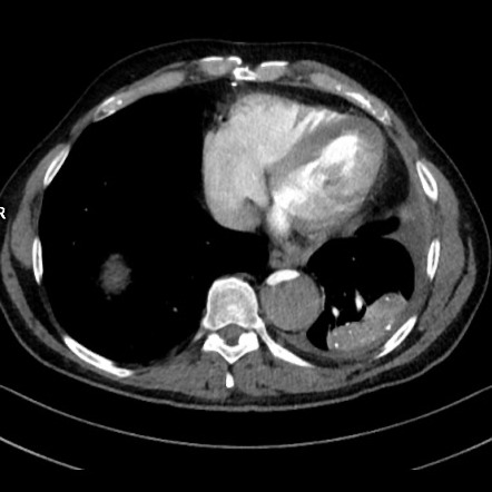 Round atelectasis | Image | Radiopaedia.org